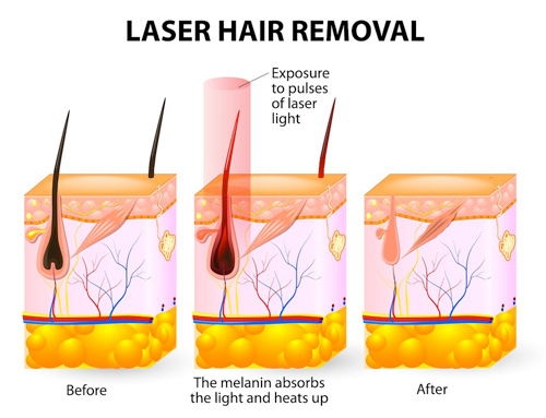 Why Does Laser Hair Removal Require Several Sessions